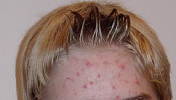 acne-scars