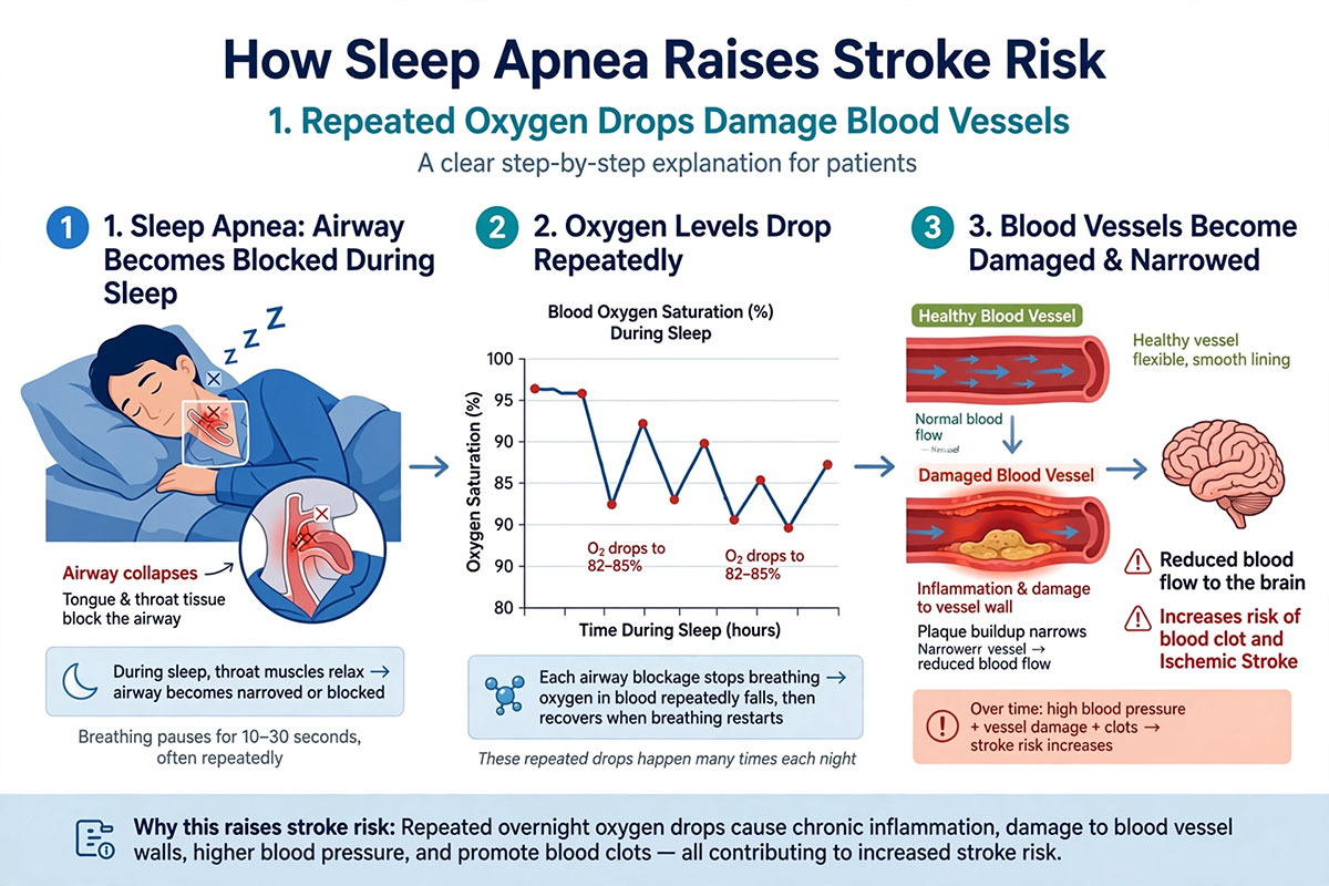 sleep apnea stroke risk